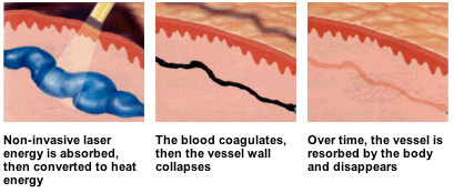 Image for IPL Treatment