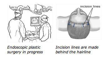 Image for Forehead Lift