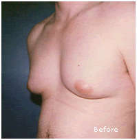 Image for Before After Gynecomastia