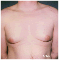 Image for Before After Gynecomastia
