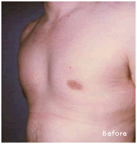 Image for Before After Gynecomastia